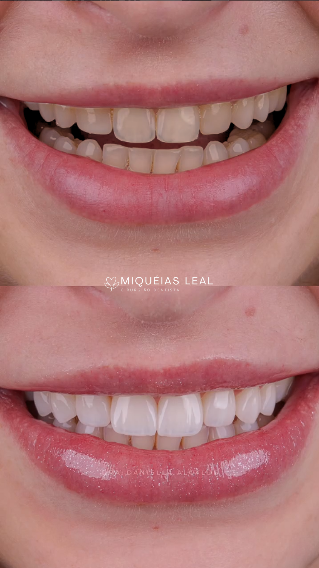 Transformação de Sorriso